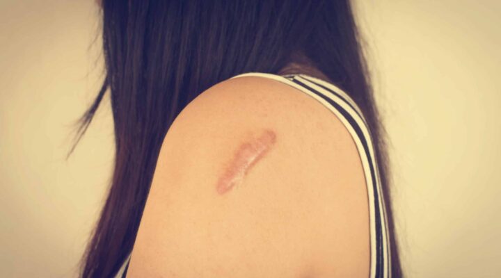 Chica joven con queloide en el brazo tras una mala cicatrización