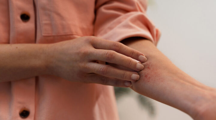 Erupción en el brazo causada por herpes zóster o culebrilla